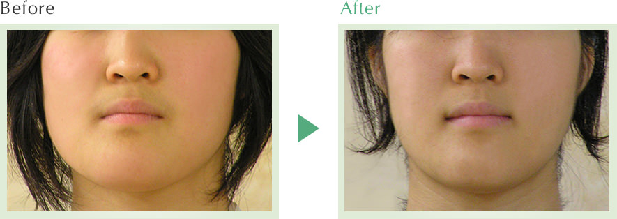 Before / After